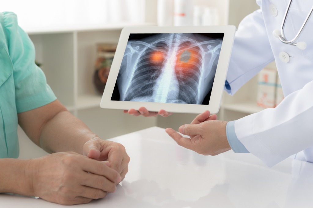Lung cancer screening guidelines￼