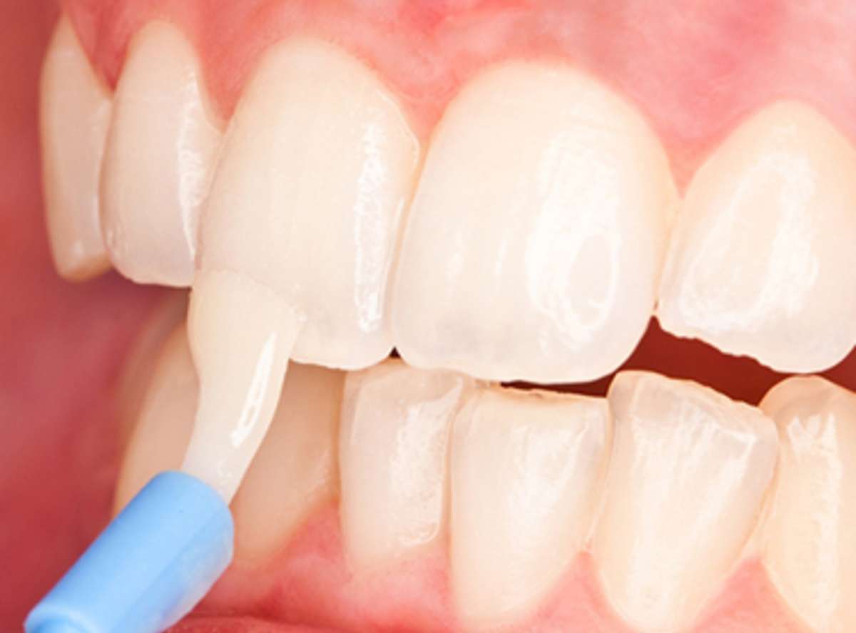 What are the Types of Teeth Problems